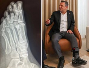 Özgür Özel’den “Vuruldu” tezlerine sert tepki! Ayağındaki kırıkların sinemaları yayınlandı