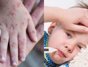 Kızamık ve boğmacaya karşı uzmanlar uyarıyor: Olaylar artıyor, önlemleri almak gerekiyor